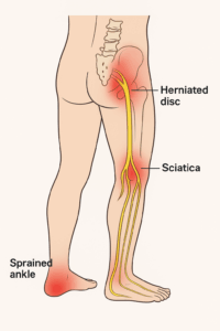 Nervio ciatico, toda la pierna